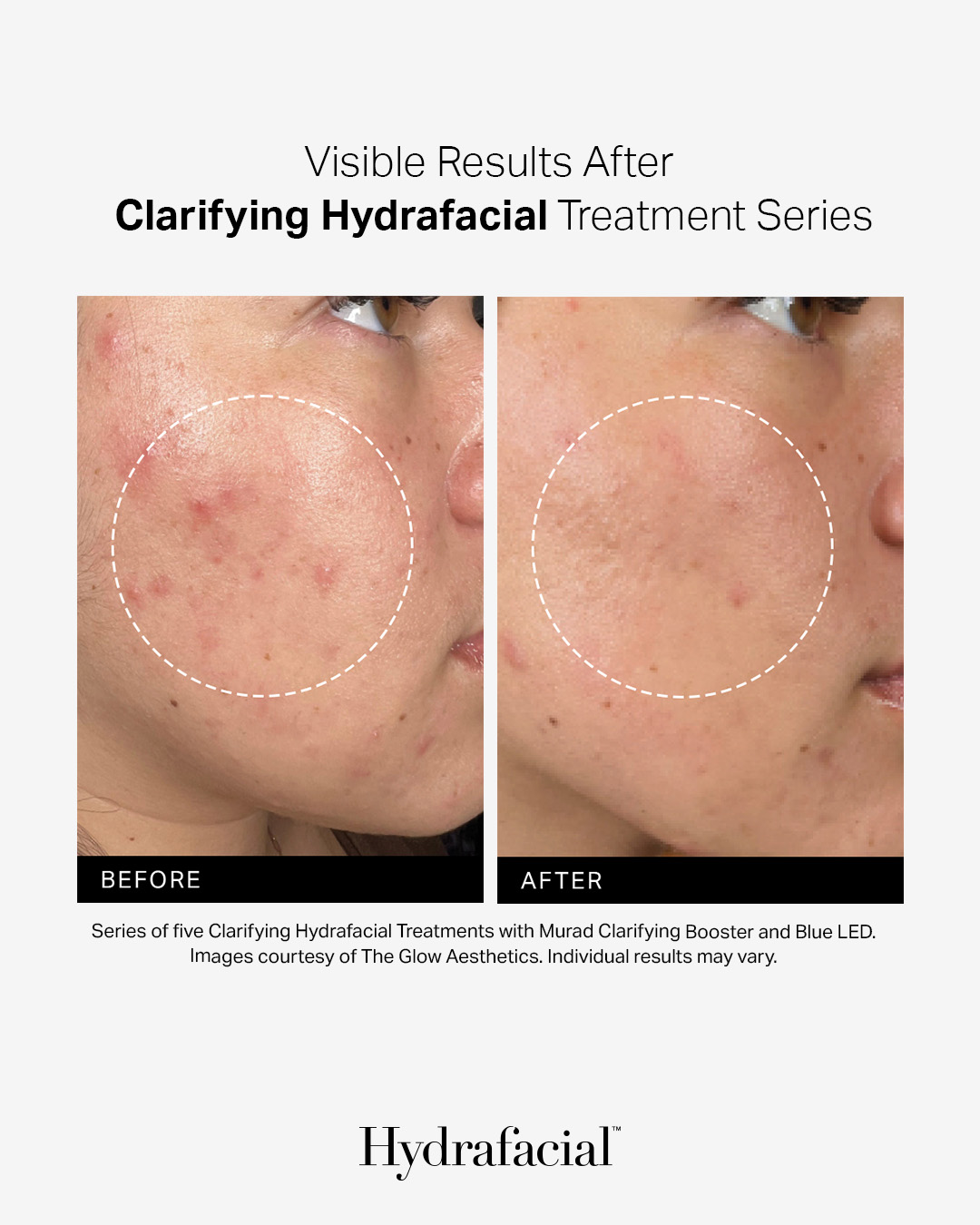 Før og efter fem Clarifying Hydrafacial-behandlinger